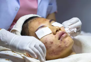 Acne Treatment