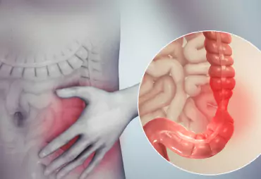 Irritable Bowel Syndrome (IBS)