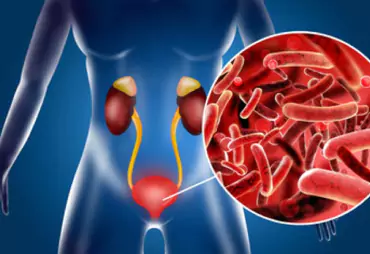 Urinary Tract Infections (UTIs)